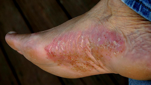 Los medios chinos a la psoriasis